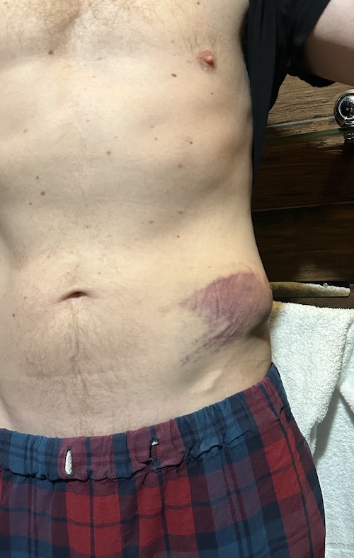 A photo of a naked man's torso showing a livid purple bruise above the left hip